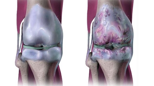 Gesundes Kniegelenk und von Arthrose betroffen