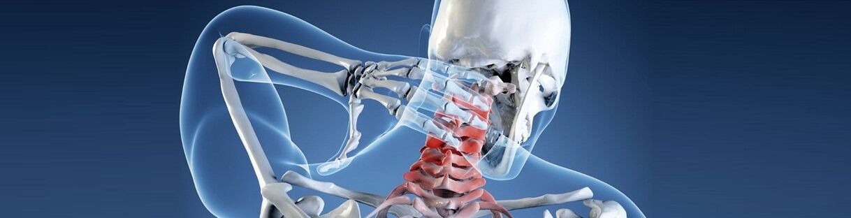 Osteochondrose der menschlichen Halswirbelsäule