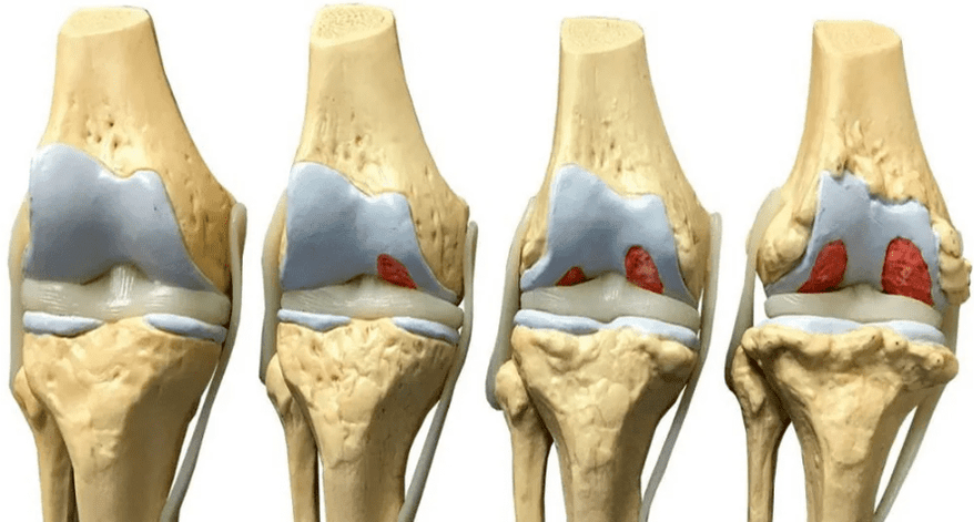 Schädigung des Kniegelenks in verschiedenen Stadien der Arthroseentwicklung