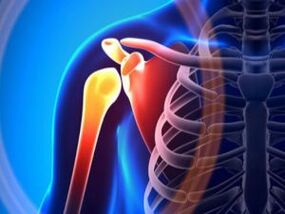 Entzündetes Schultergelenk durch Arthrose – eine chronische Erkrankung des Bewegungsapparates