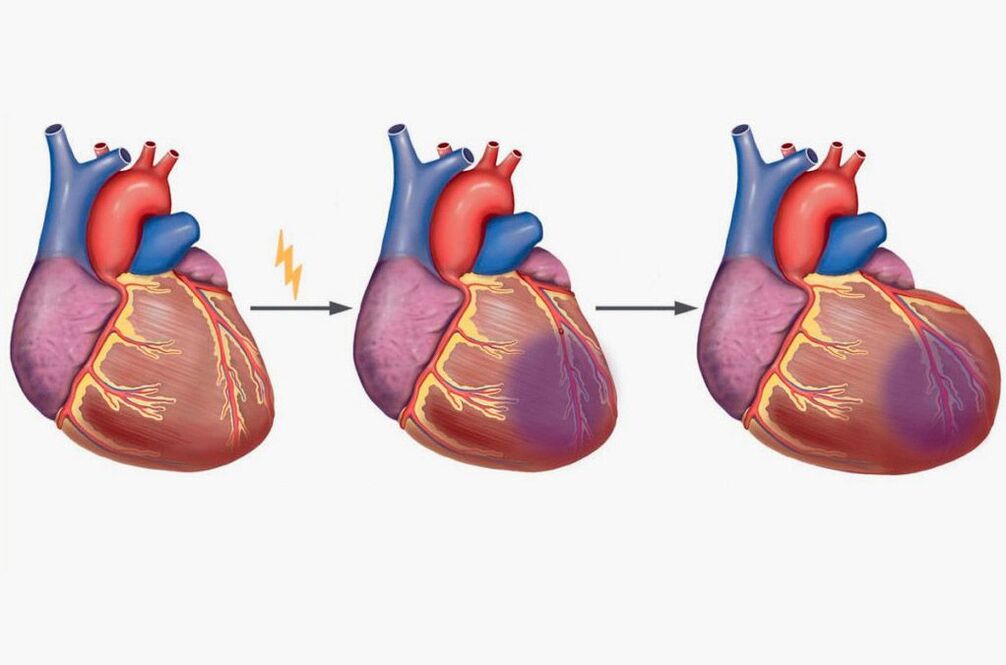 Ein Herzinfarkt führt zu Schmerzen in den Schulterblättern