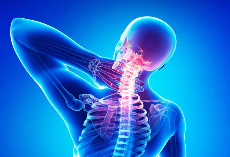 Osteochondrose der Halswirbelsäule