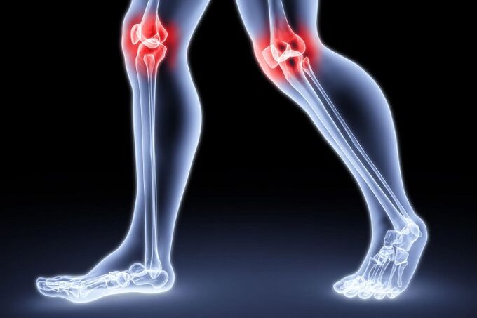 Knieschmerzen aufgrund von Arthritis und Arthrose