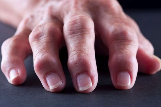 Verformung der Fingergelenke mit Arthritis und Arthrose