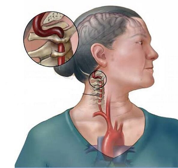 Wirbelarteriensyndrom mit zervikaler Osteochondrose