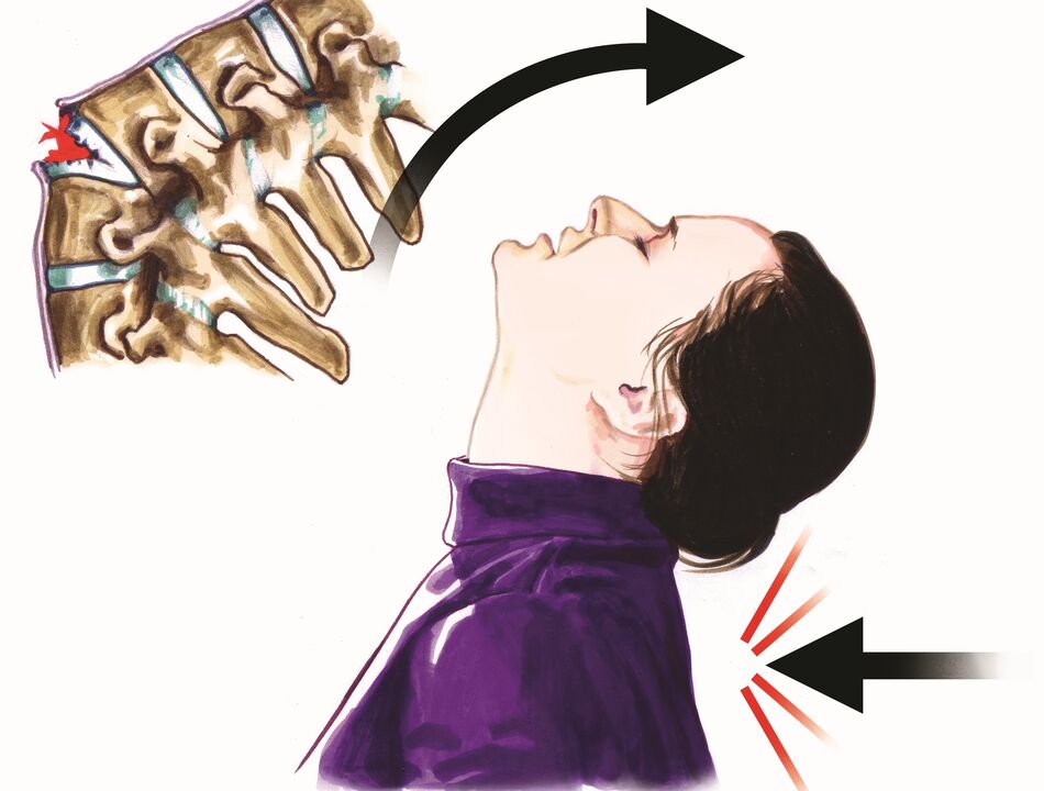 Wirbelsäulenschäden als Ursache für Nackenschmerzen